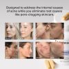Hormonal Acne Supplement (5-HTP) - 30 Servings, 90 Capsules - capsule-2