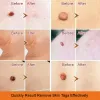 Wart Spot Nevus Remover Cream Freckle Face Wart Tag Treatment Removal Essential Oil - 20g